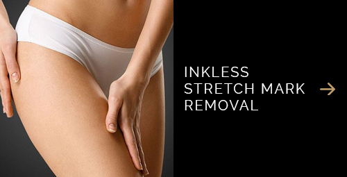Inkless Stretch Mark Removal