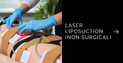 Laser Liposuction Non-Surgical