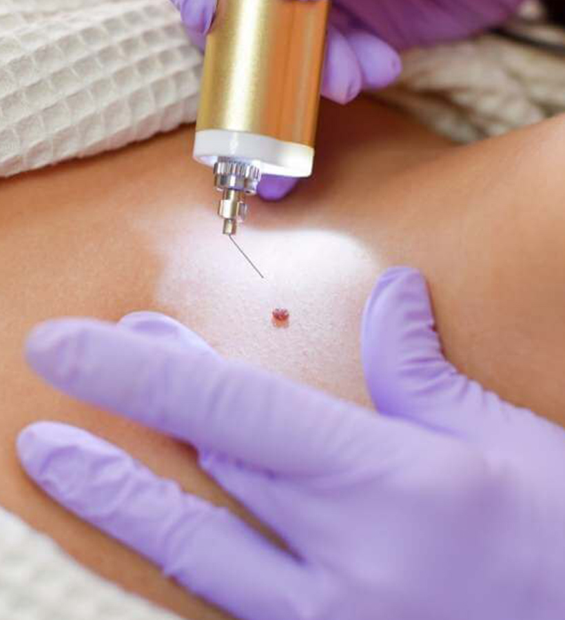 Adore Skin Studio - Skin Tag & Mole Removal