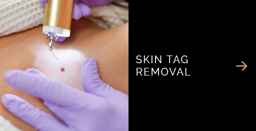 Adore Skin Studio Med Spa Skin Tag Removal